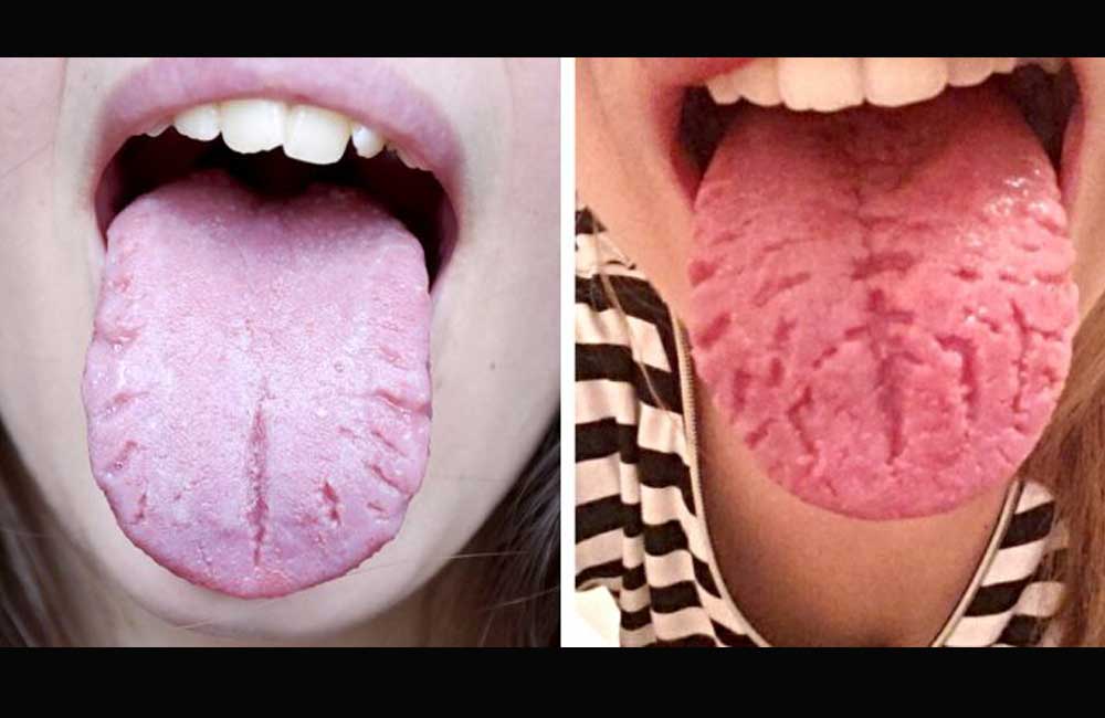 Advierte IMSS sobre enfermedades que se reflejan en la lengua e ignoramos