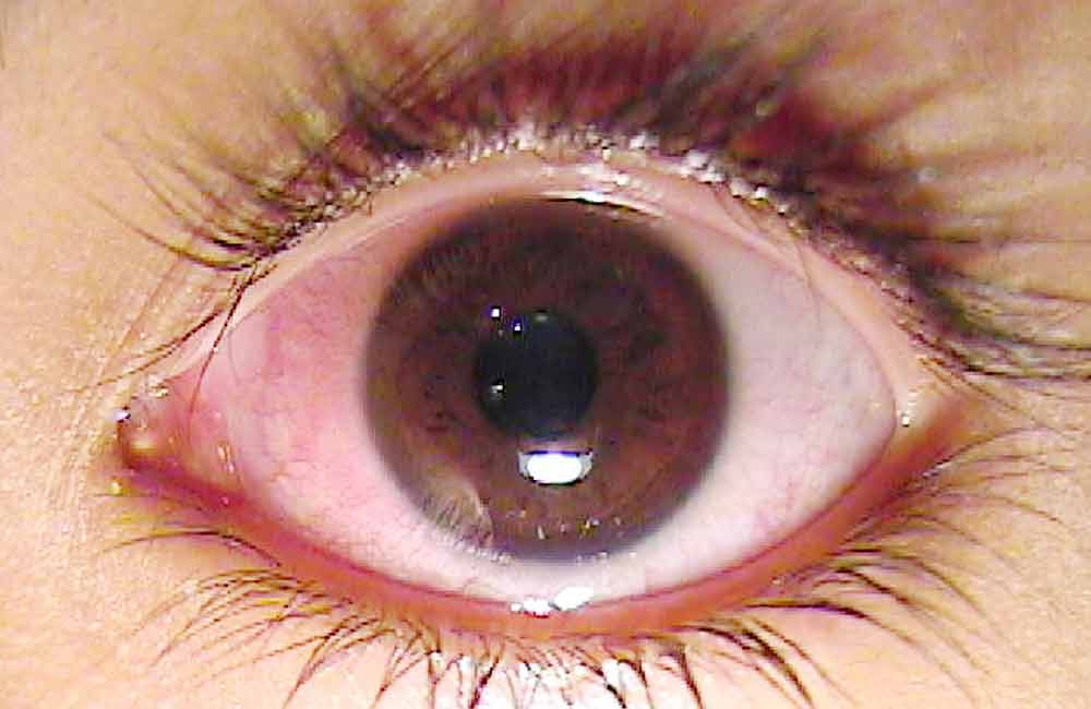 Hormigueo, secreciones y picazón en los ojos: es síntoma de conjuntivitis