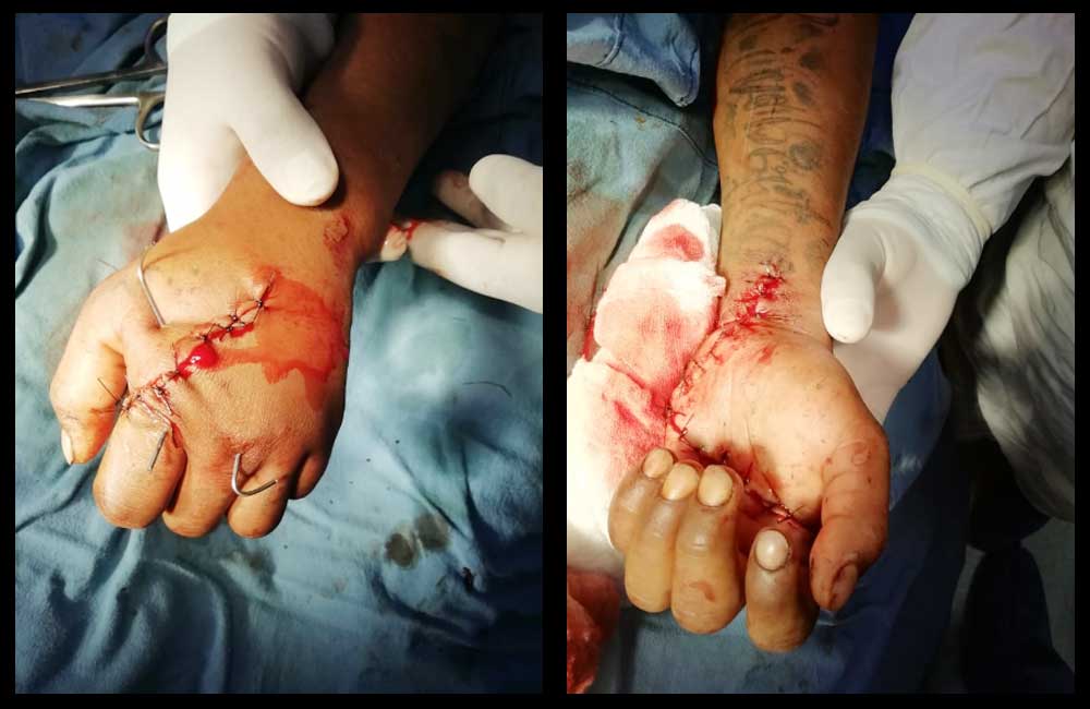 Salvan la mano a joven en Hospital de Putla Villa de Guerrero