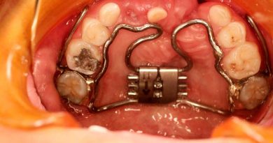 Brindan los SSO tratamiento integral a pacientes con labio y paladar hendido Brindan los SSO tratamiento integral a pacientes con labio y paladar hendido