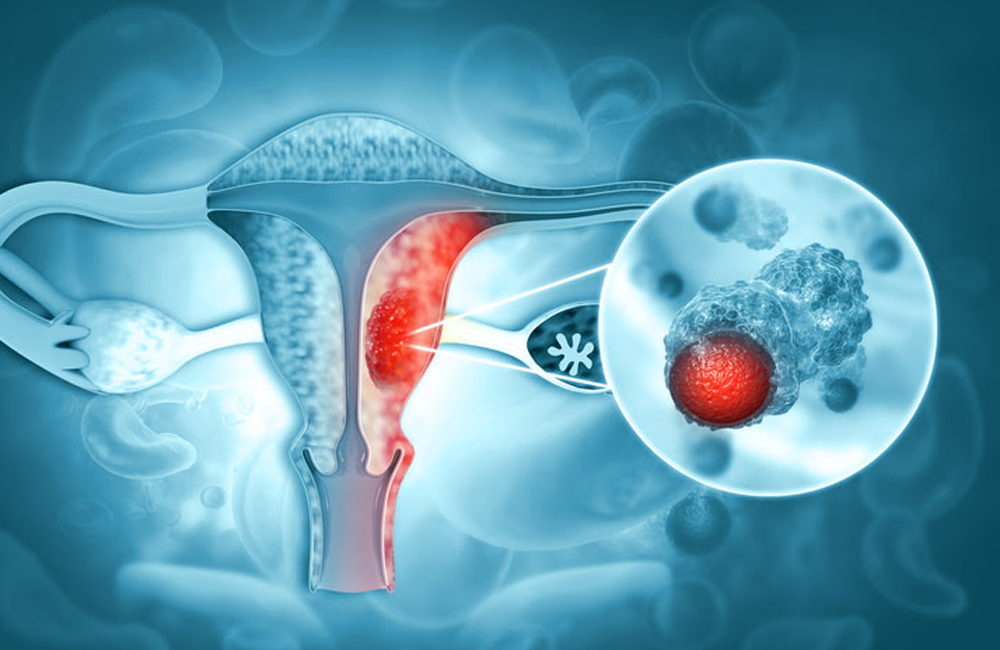 Detectan cáncer de ovario con más frecuencia en mujeres de 50 años