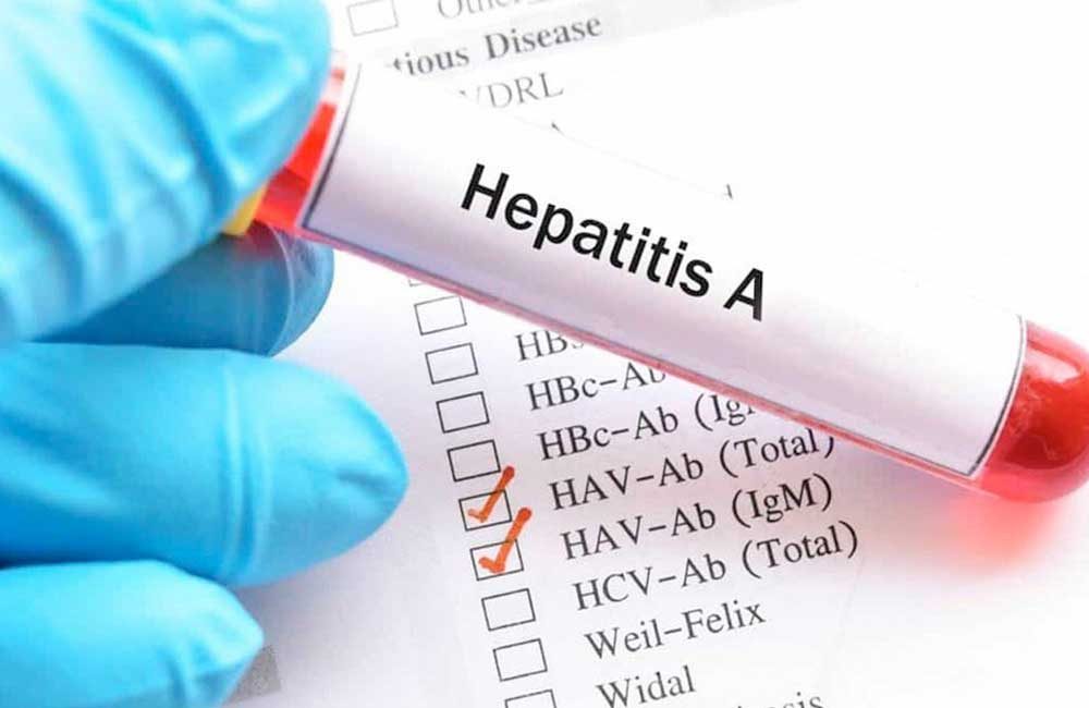 Hepatitis-A