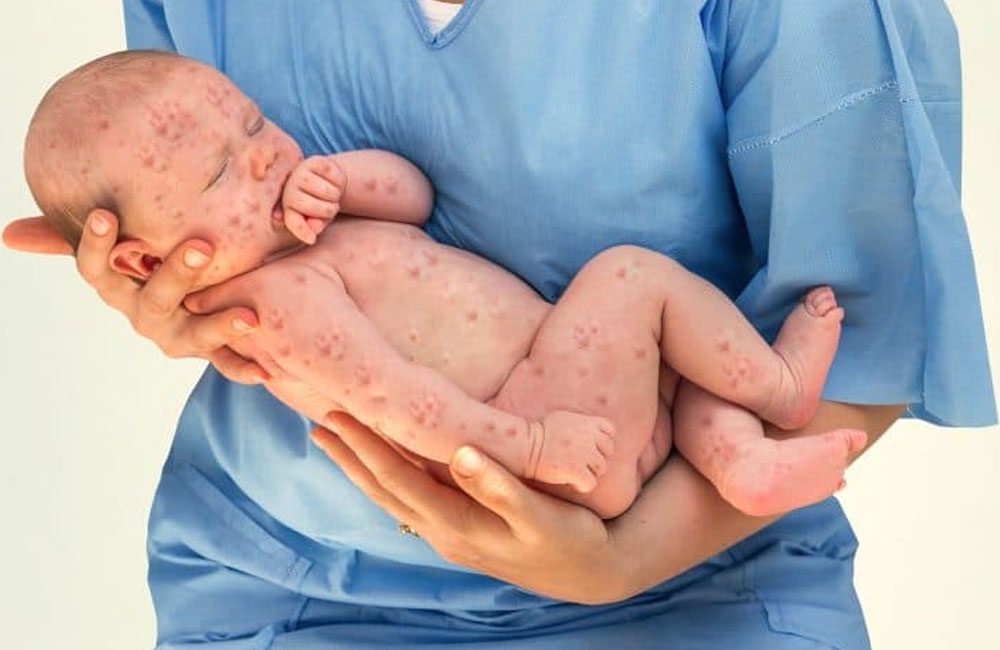 Viruela símica en bebés